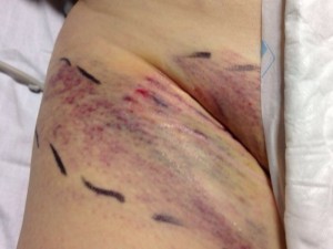 hematoma